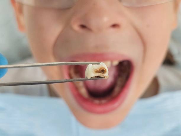 Best Emergency Tooth Extraction in Elizabethtown, NC
